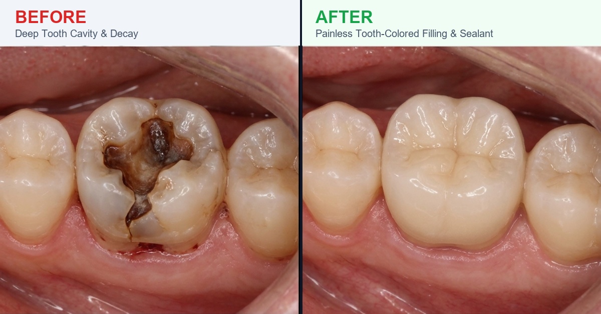 Painless Tooth Cavity Treatment and Sealant Guntur